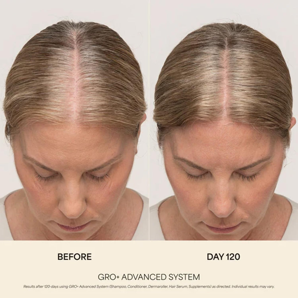 VEGAMOUR GRO+ Advanced Hair Serum | Improves Hair Density, Reduces Shedding and Promotes a Balanced Scalp | For Severe Signs of Thinning | Formulated Without Fragrance, Vegan, Cruelty-Free