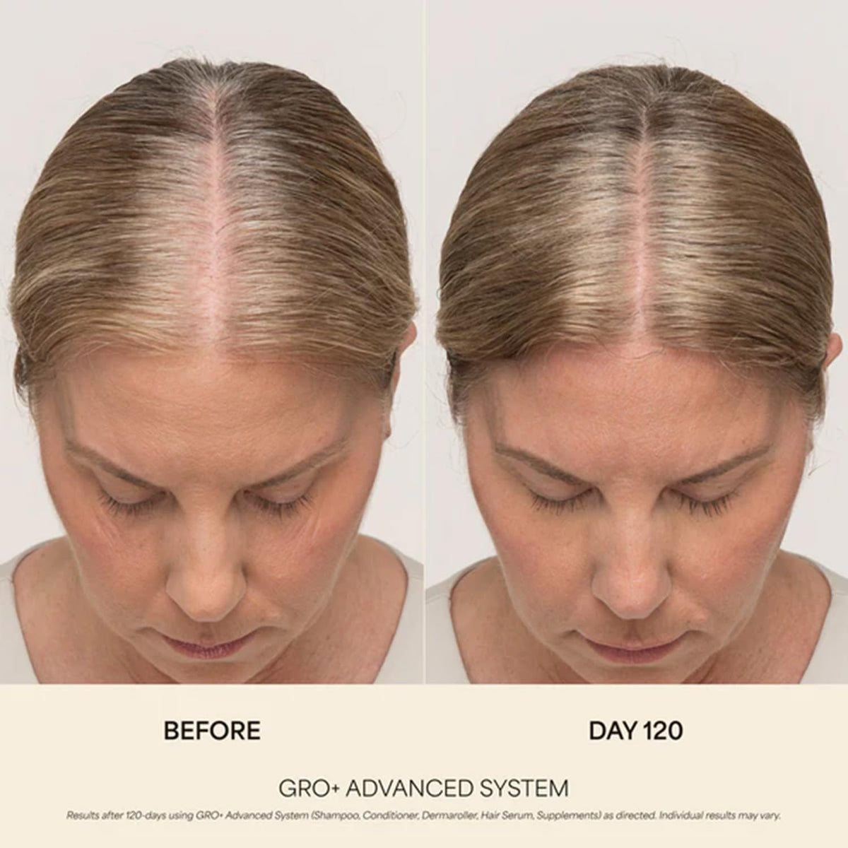 VEGAMOUR GRO+ Advanced Hair Serum | Improves Hair Density, Reduces Shedding and Promotes a Balanced Scalp | For Severe Signs of Thinning | Formulated Without Fragrance, Vegan, Cruelty-Free