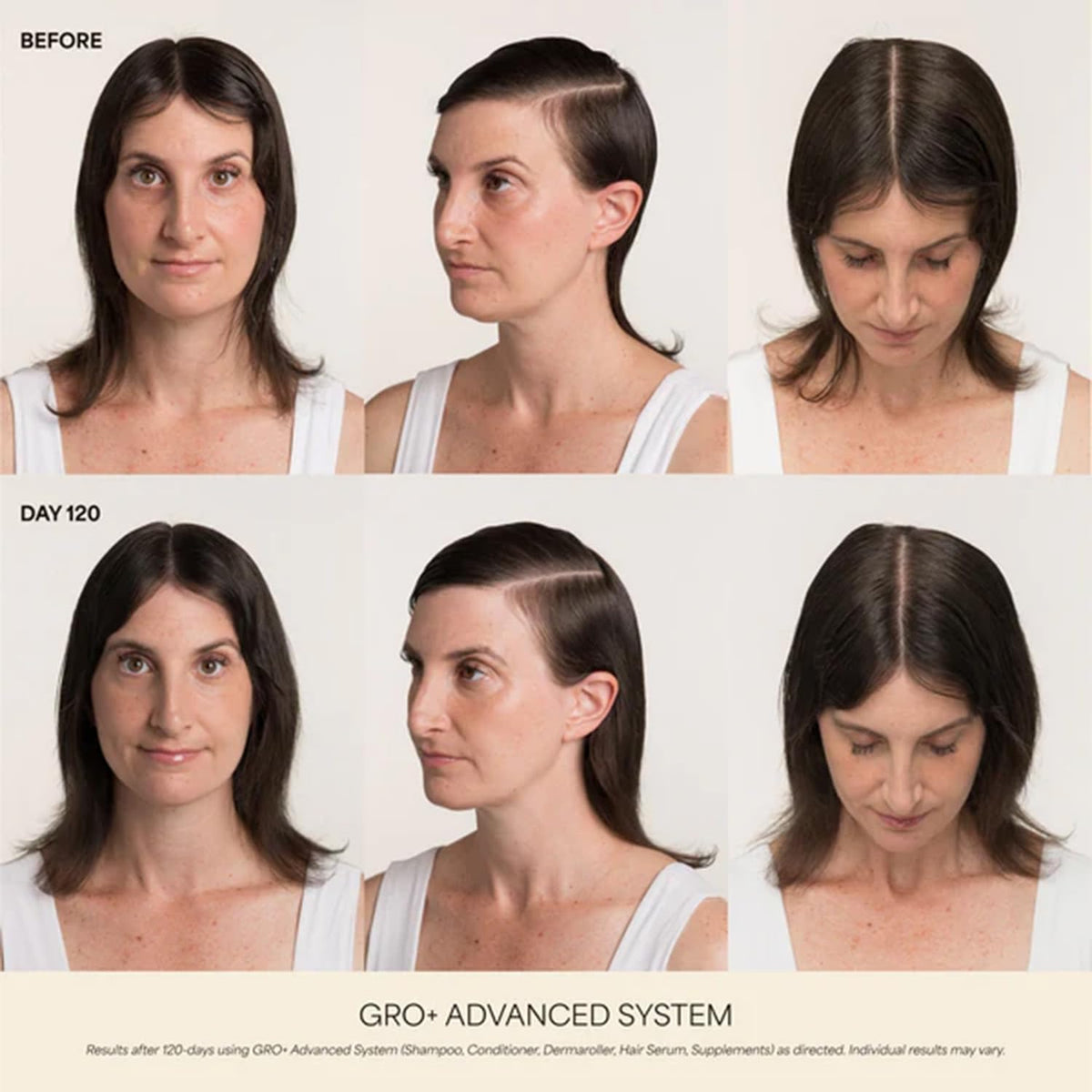 VEGAMOUR GRO+ Advanced Hair Serum | Improves Hair Density, Reduces Shedding and Promotes a Balanced Scalp | For Severe Signs of Thinning | Formulated Without Fragrance, Vegan, Cruelty-Free