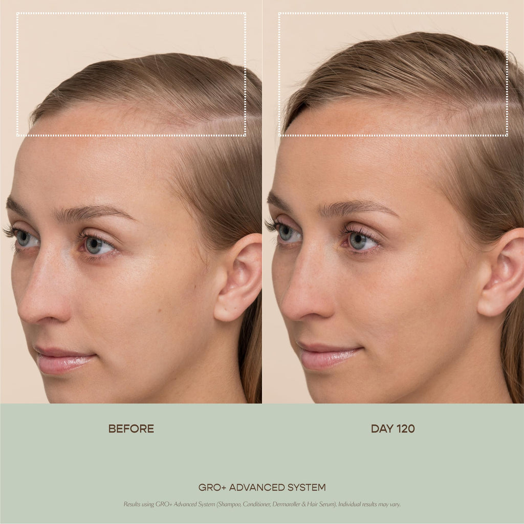 VEGAMOUR GRO+ Advanced Hair Serum | Improves Hair Density, Reduces Shedding and Promotes a Balanced Scalp | For Severe Signs of Thinning | Formulated Without Fragrance, Vegan, Cruelty-Free