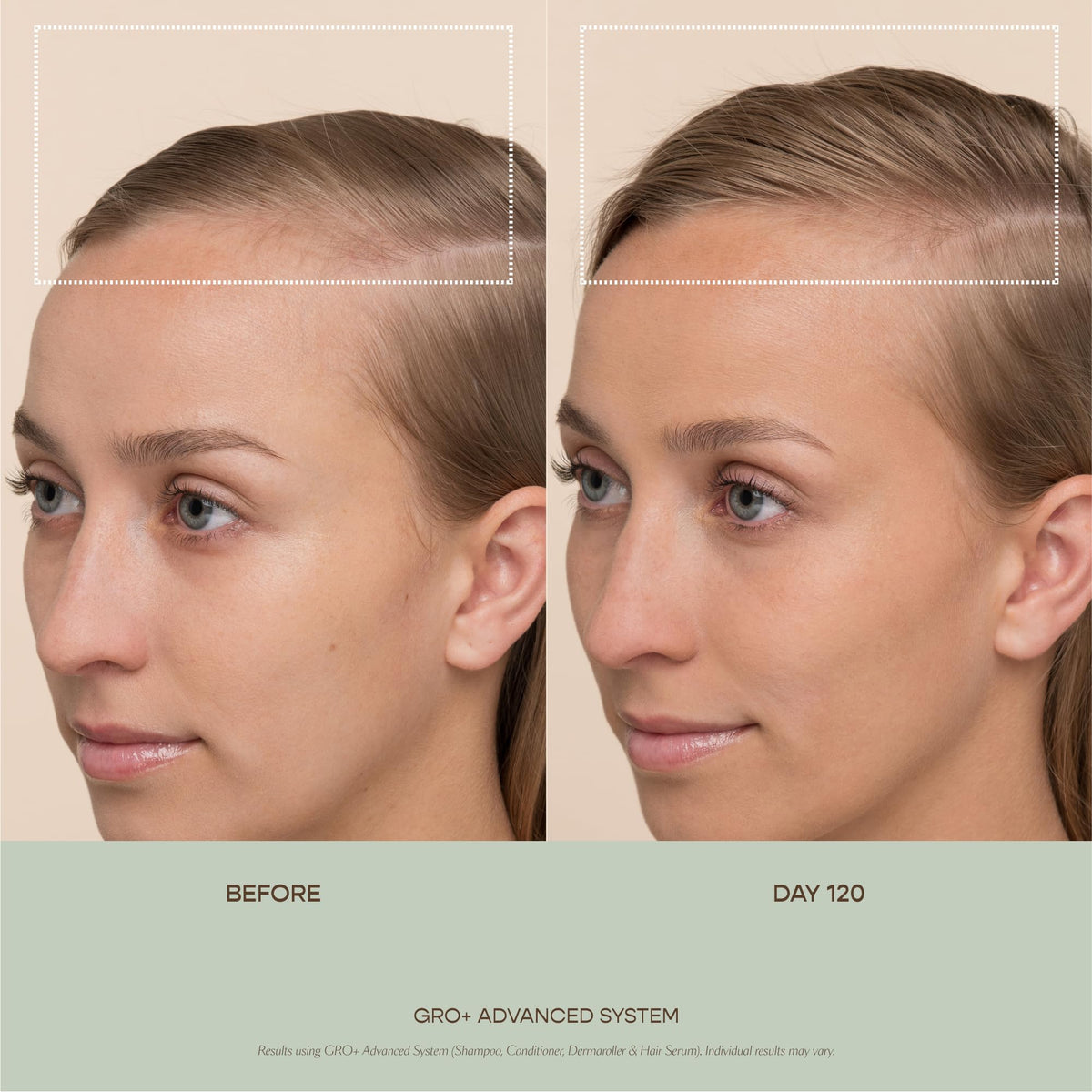 VEGAMOUR GRO+ Advanced Hair Serum | Improves Hair Density, Reduces Shedding and Promotes a Balanced Scalp | For Severe Signs of Thinning | Formulated Without Fragrance, Vegan, Cruelty-Free